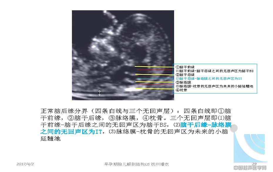 早孕期胎儿解剖结构超声检查及相关问题_页面_029.jpg