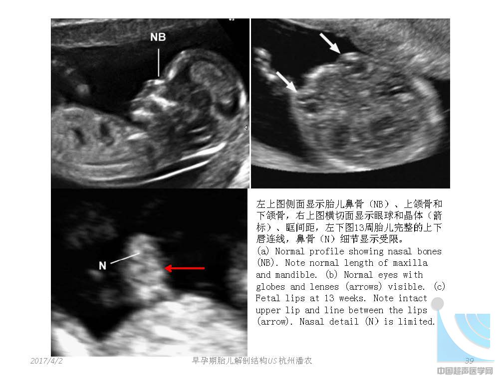早孕期胎儿解剖结构超声检查及相关问题_页面_039.jpg