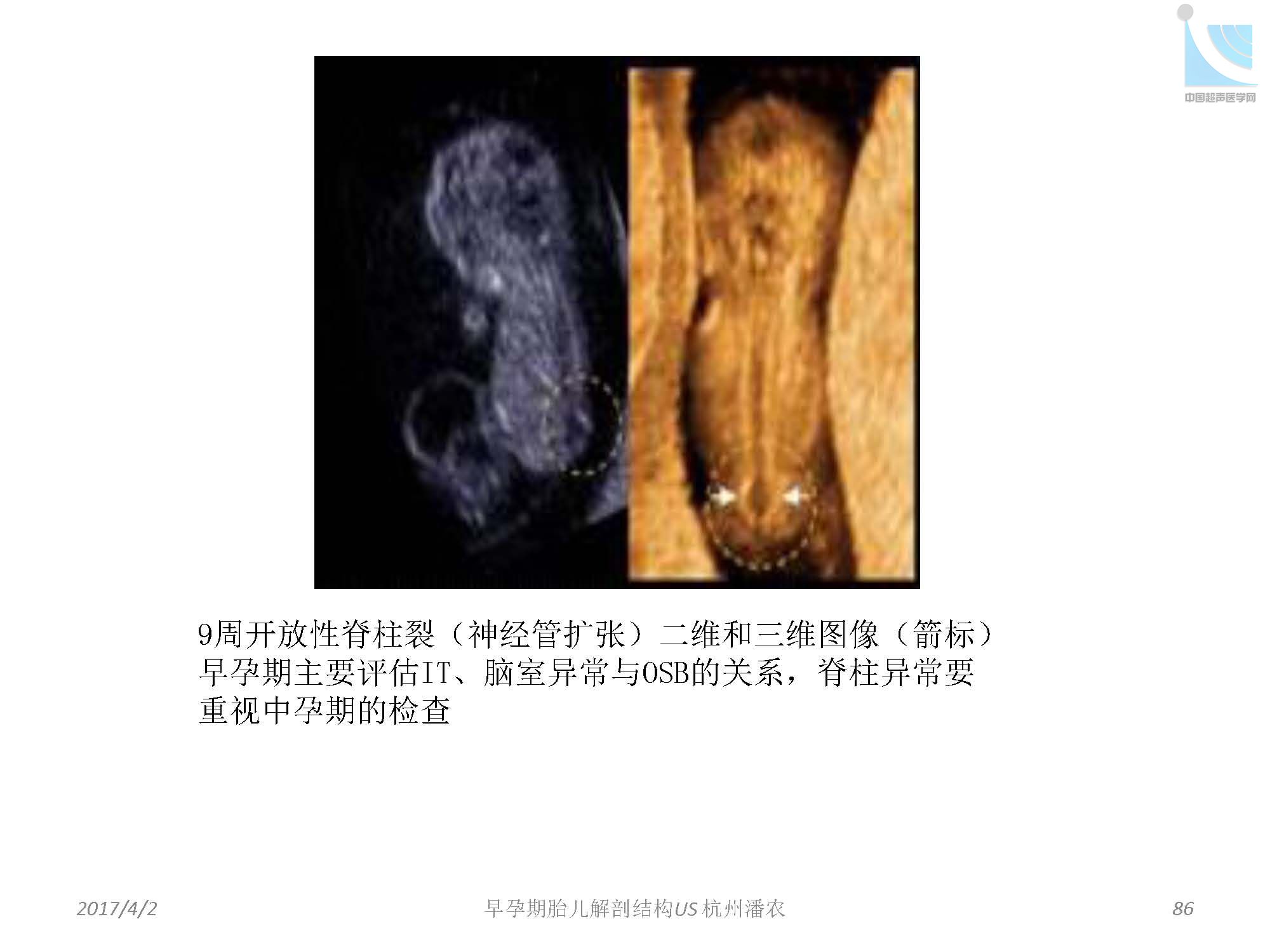 早孕期胎儿解剖结构超声检查及相关问题_页面_086.jpg