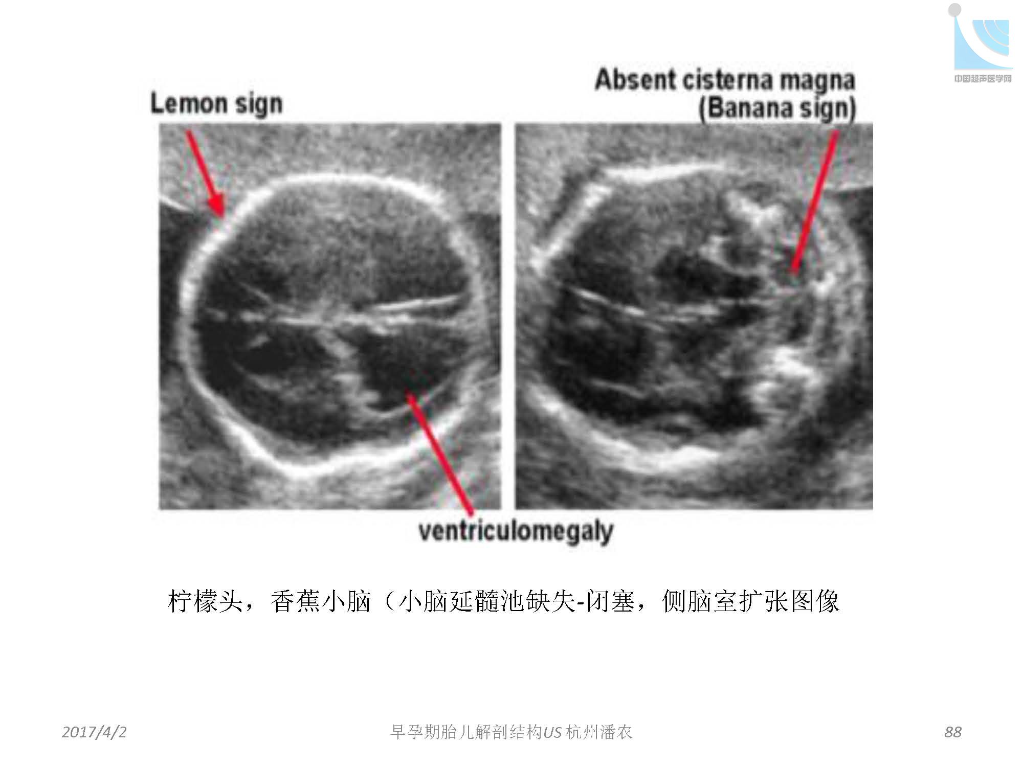 早孕期胎儿解剖结构超声检查及相关问题_页面_088.jpg