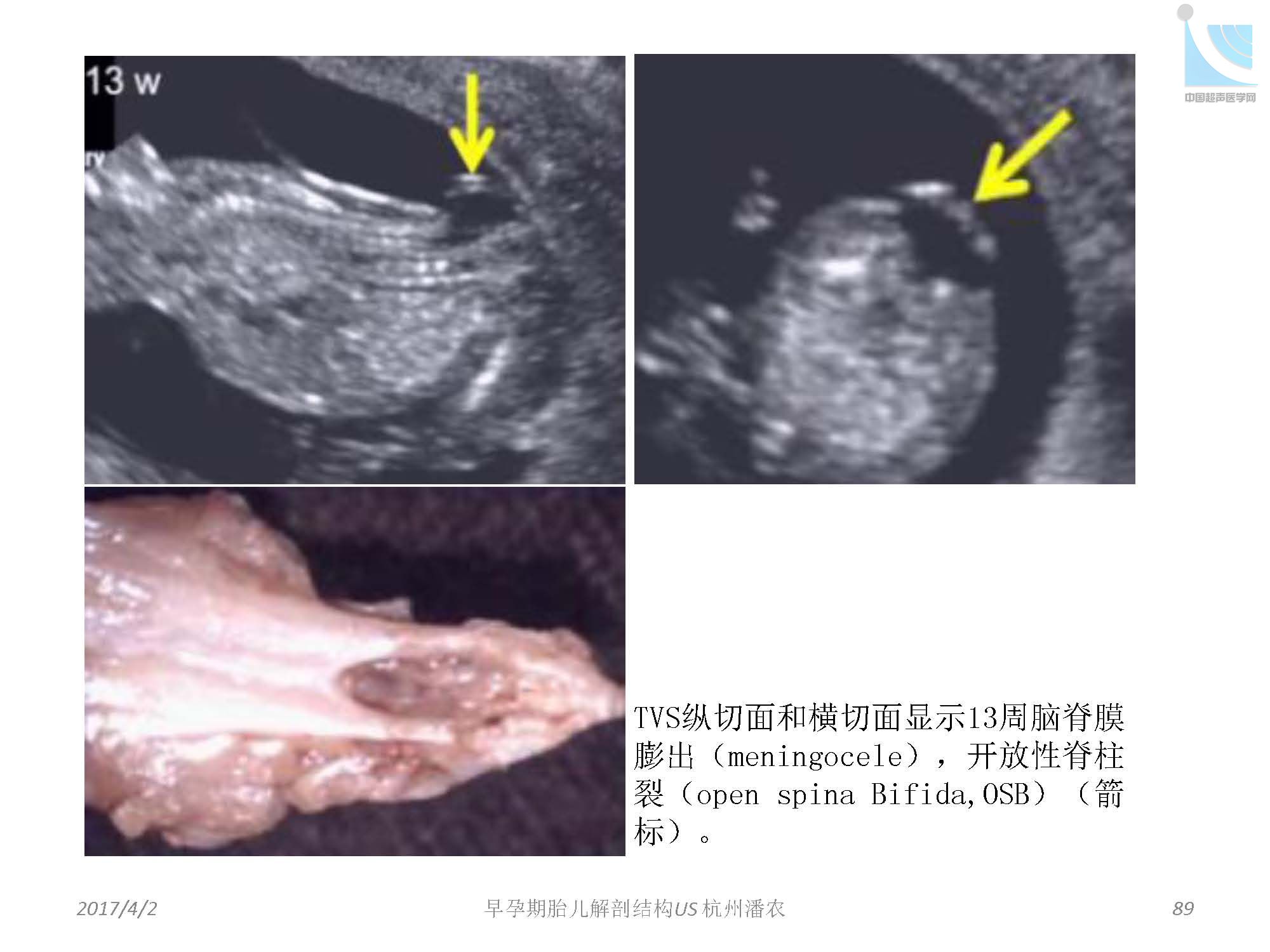 早孕期胎儿解剖结构超声检查及相关问题_页面_089.jpg