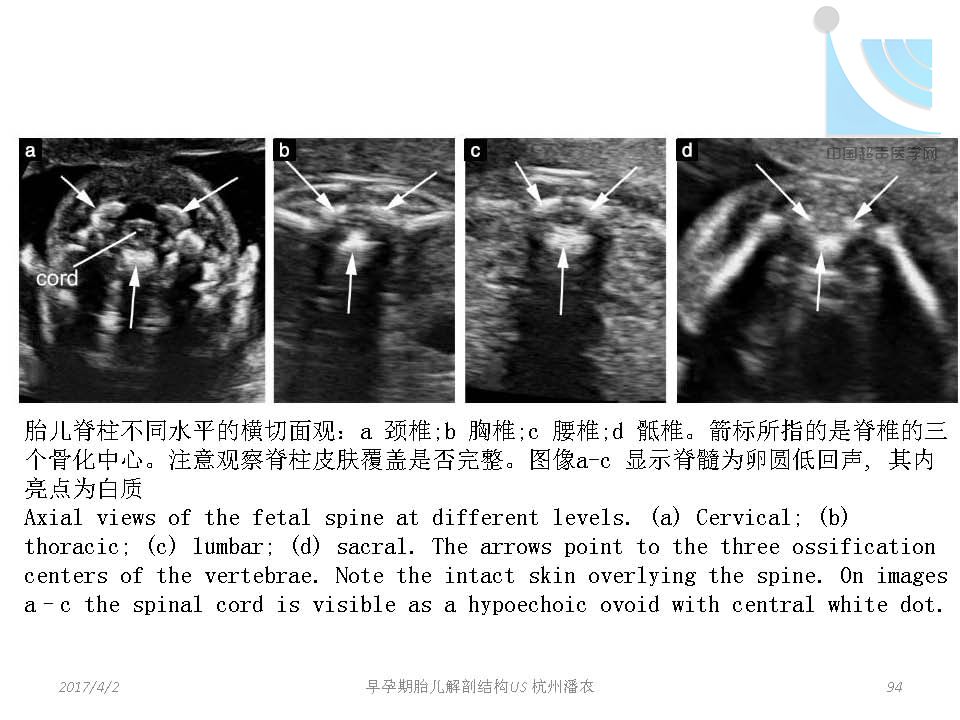 早孕期胎儿解剖结构超声检查及相关问题_页面_094.jpg