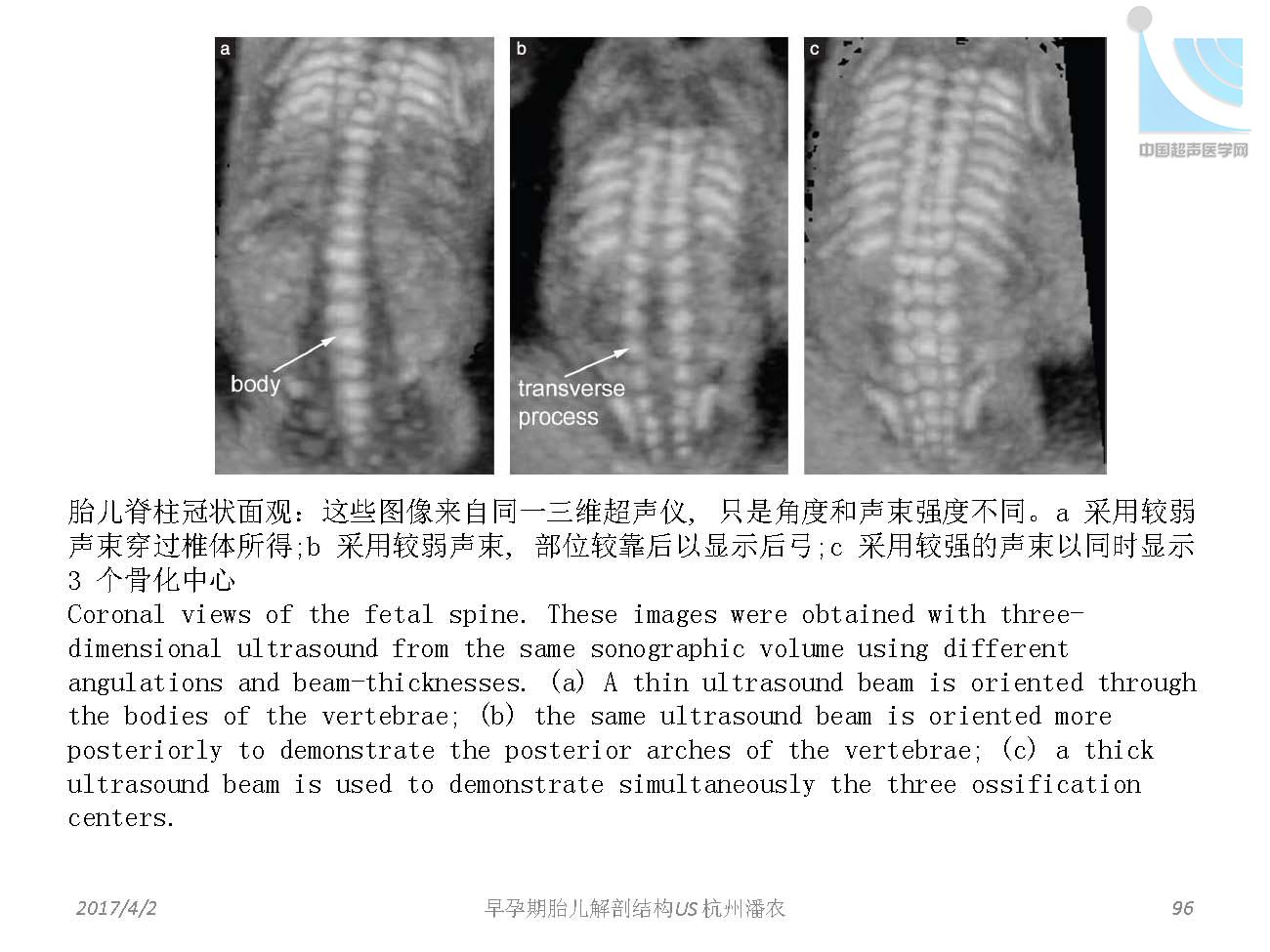 早孕期胎儿解剖结构超声检查及相关问题_页面_096.jpg