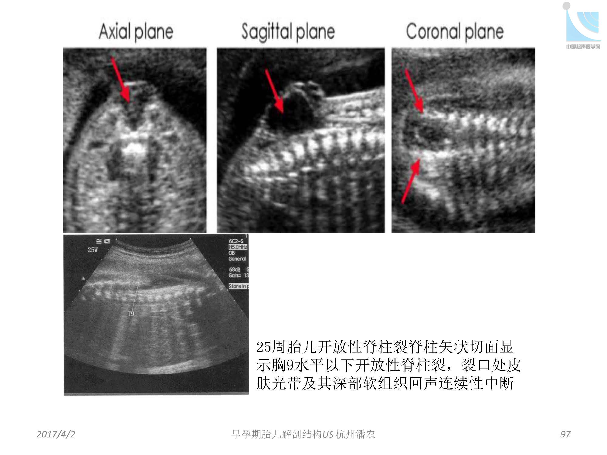 早孕期胎儿解剖结构超声检查及相关问题_页面_097.jpg