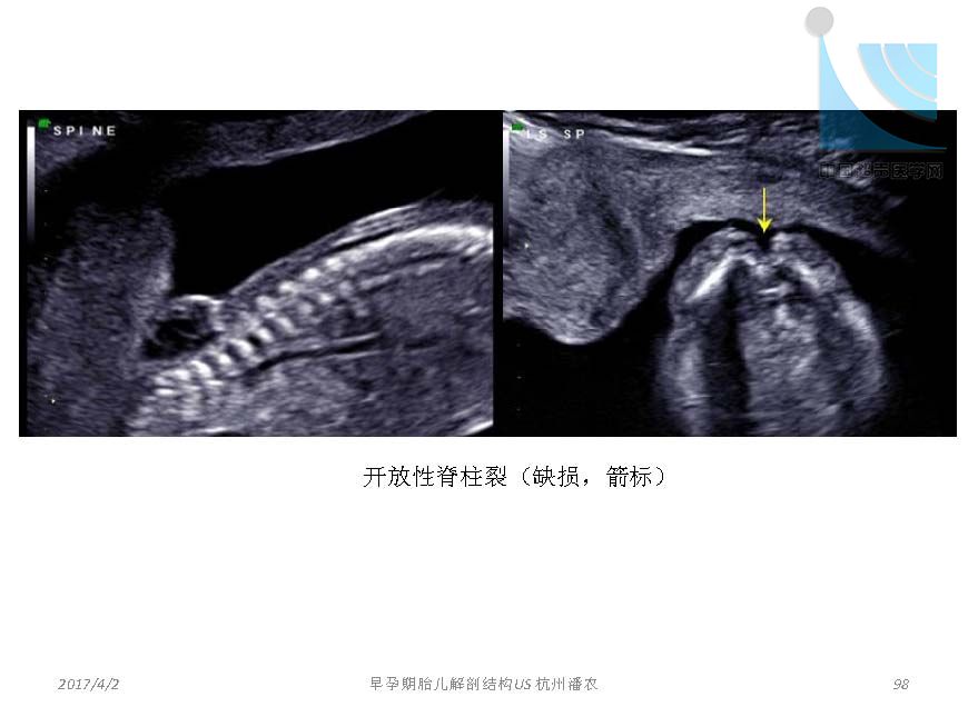 早孕期胎儿解剖结构超声检查及相关问题_页面_098.jpg