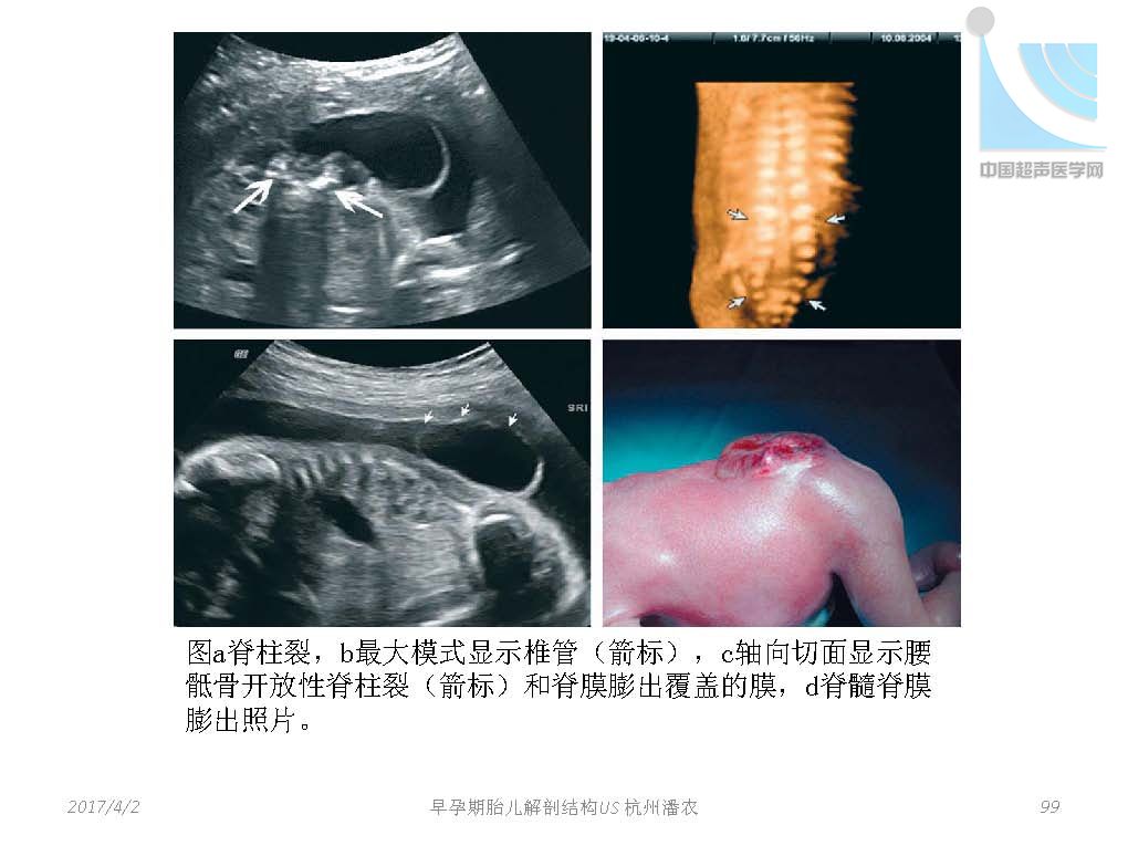 早孕期胎儿解剖结构超声检查及相关问题_页面_099.jpg