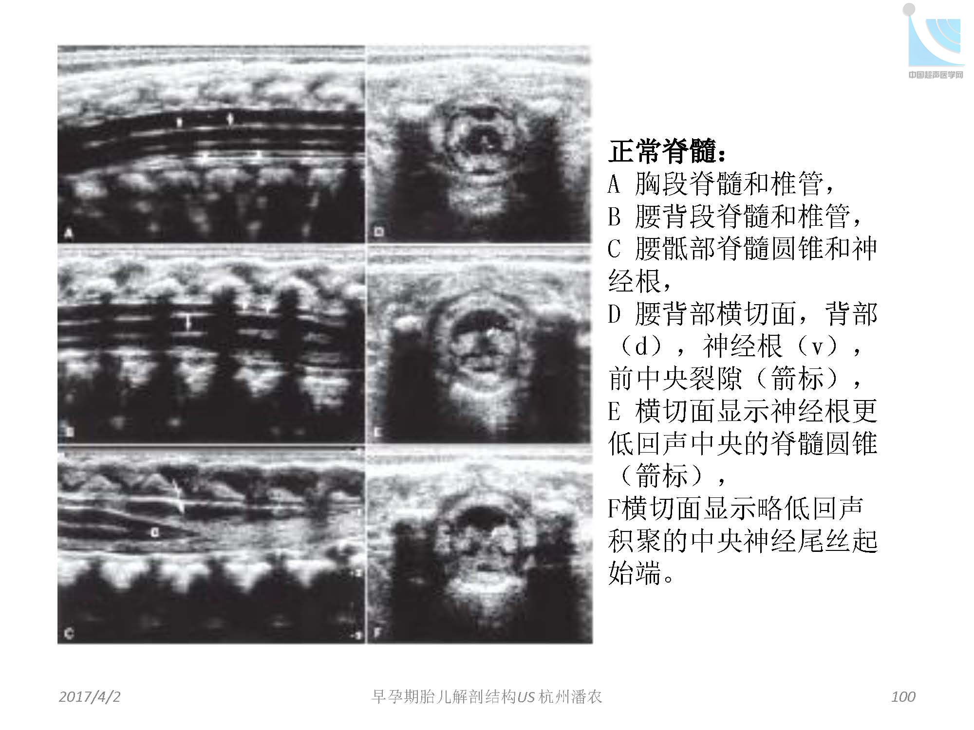 早孕期胎儿解剖结构超声检查及相关问题_页面_100.jpg