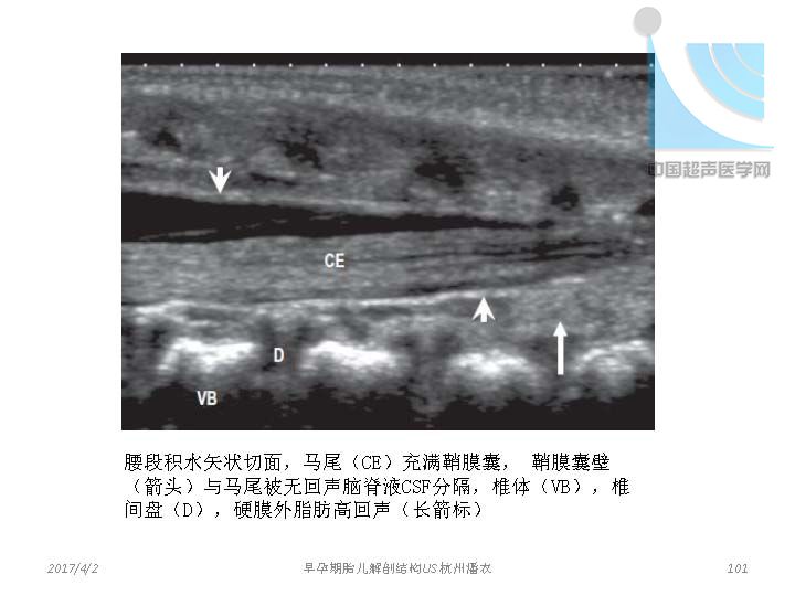早孕期胎儿解剖结构超声检查及相关问题_页面_101.jpg