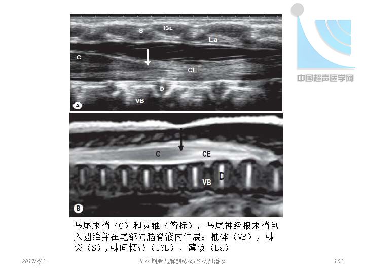 早孕期胎儿解剖结构超声检查及相关问题_页面_102.jpg