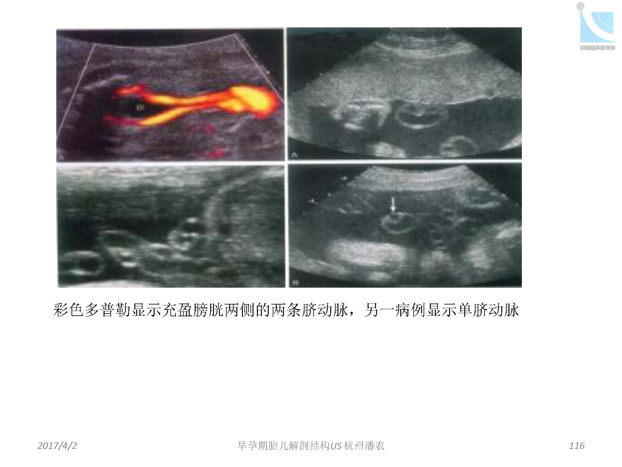 早孕期胎儿解剖结构超声检查及相关问题_页面_116.jpg