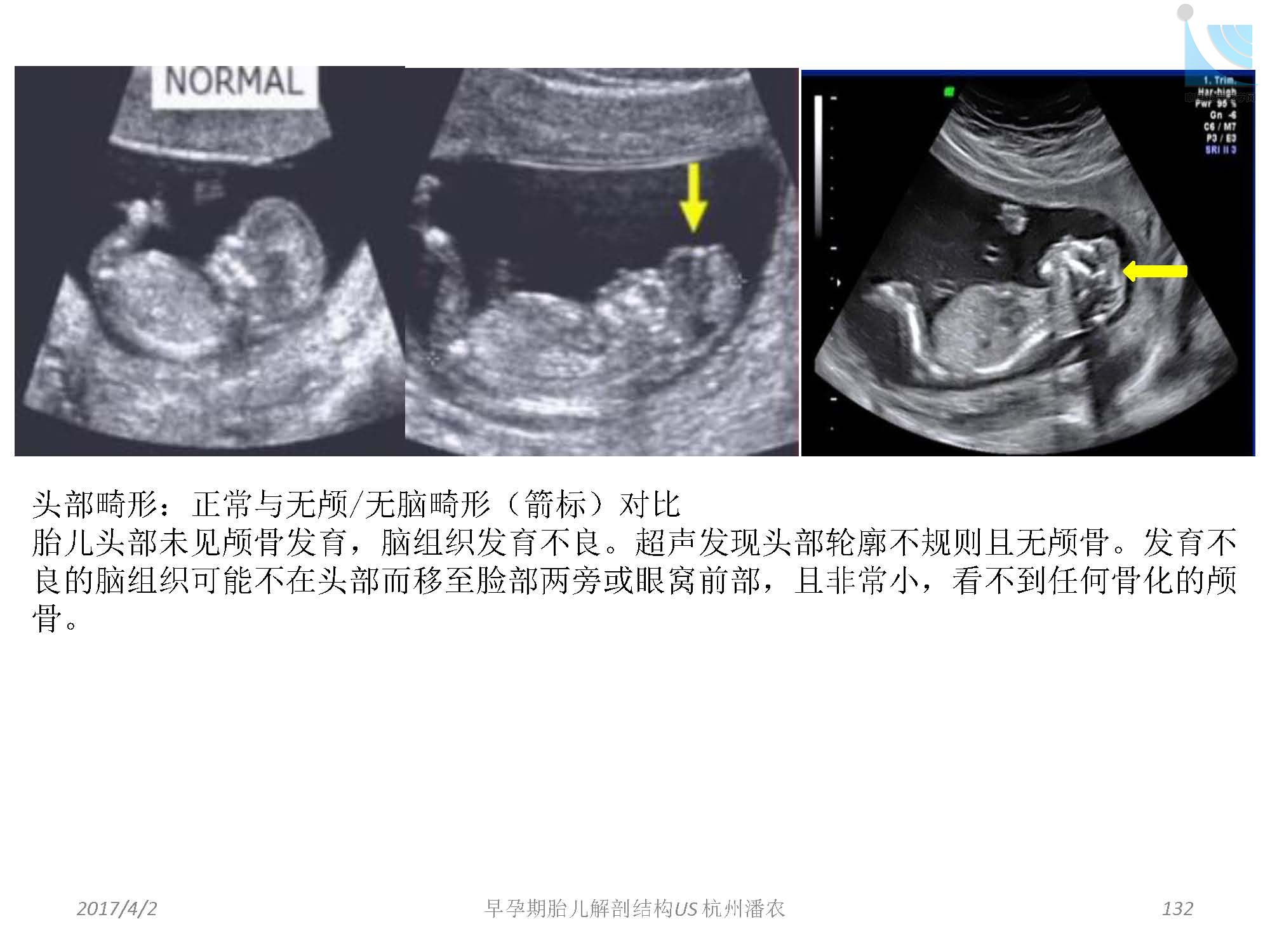 早孕期胎儿解剖结构超声检查及相关问题_页面_132.jpg